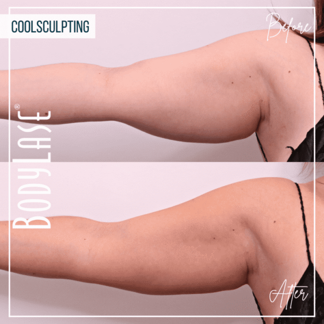 BodyLase® Med Spa - 549681586 cs b a arms e1764801707323