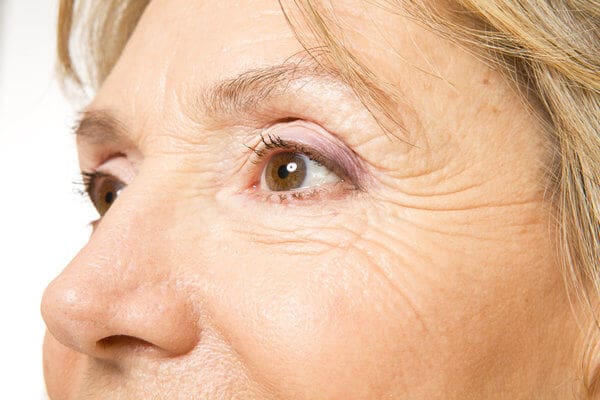 BodyLase® Med Spa - Bodylase eye wrinkles