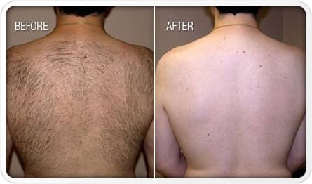 BodyLase® Med Spa - Laser Hair Removal man
