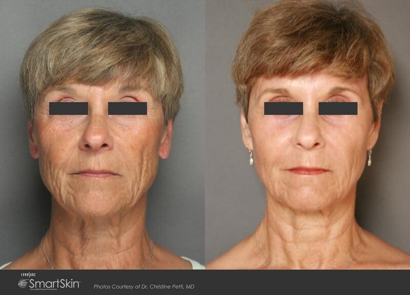 BodyLase® Med Spa - SmartSkin CO2 Laser 1
