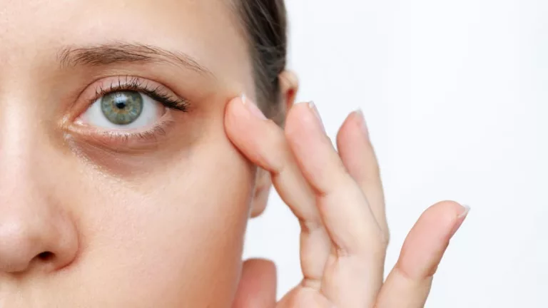 How to Get Rid of Dark Circles and Puffiness Under the Eyes