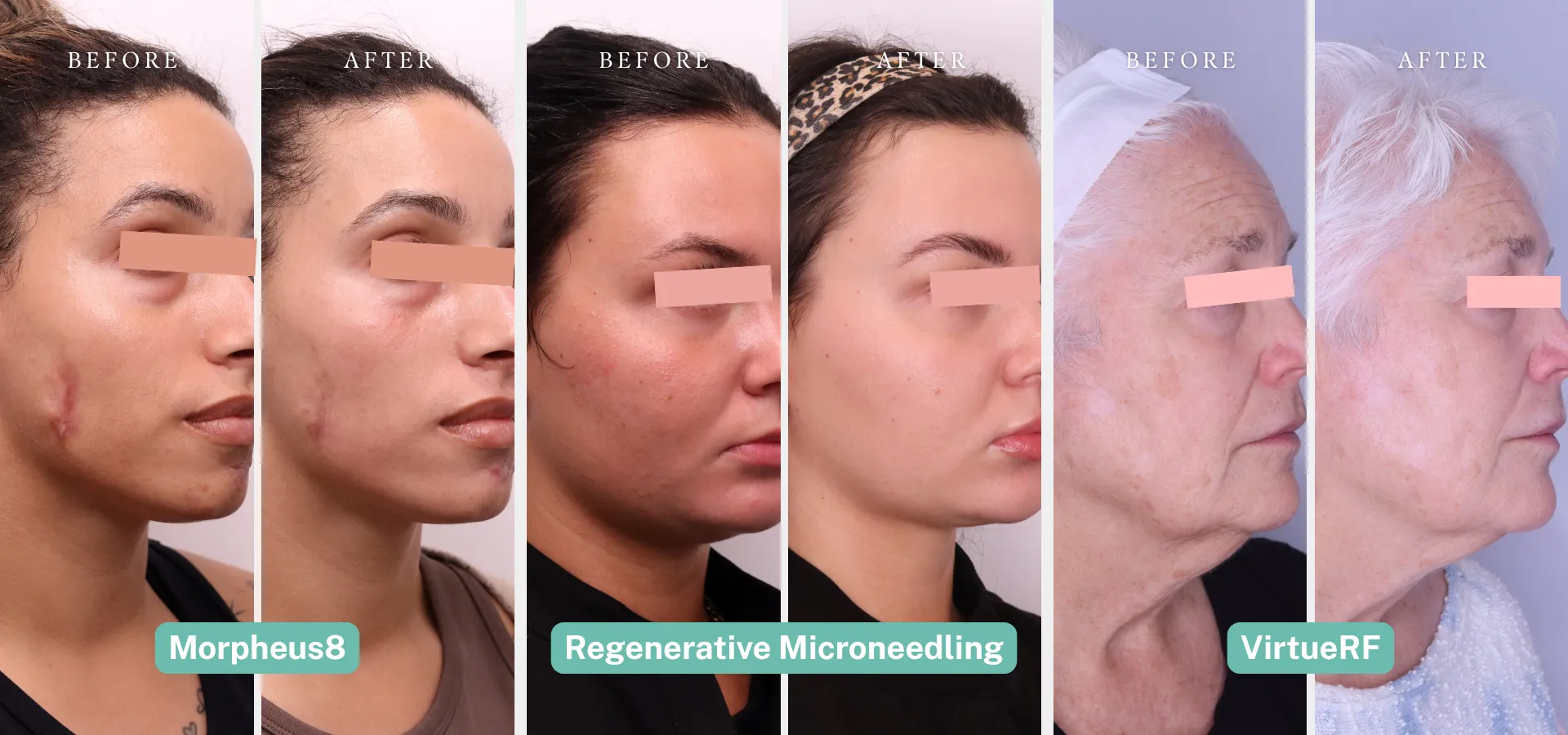 BodyLase® Med Spa - Events Graphic May 14 Microneedling